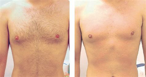 depilacao virilha|Depilação a laser virilha: confira seu antes e depois e se dói!